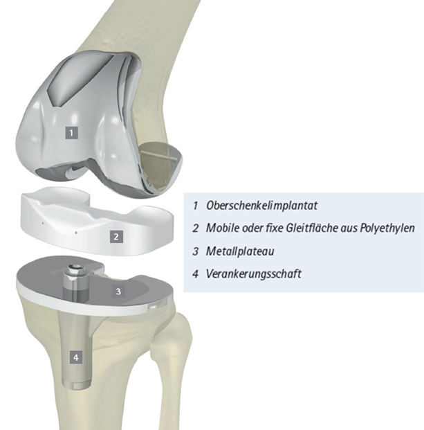 künstliches kniegelenk