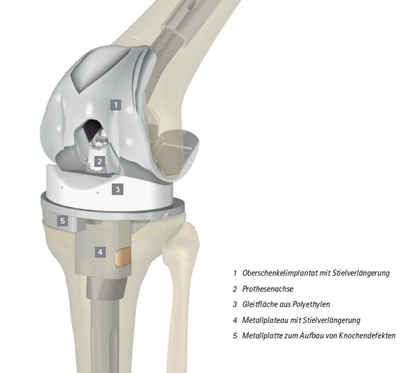 künstliches kniegelenk